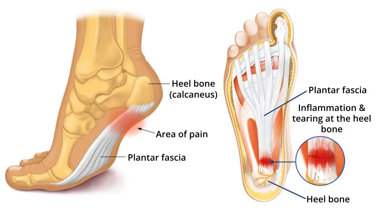 Revolutionerande ortopedisk innersula